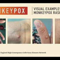 BREAKING:  Governor Newsom proclaims state of emergency to support state’s response to monkeypox