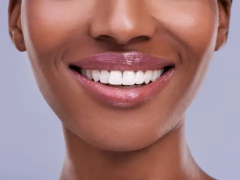 Veneers (9).webp