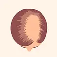 female-hair-transplant-_9_.webp