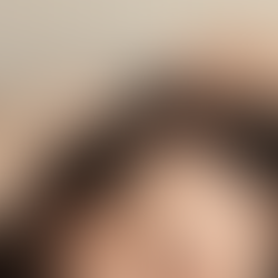 Regenera Activa in Turkey: A Revolutionary Approach to Hair Restoration