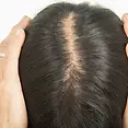 female-hair-transplant-_6_.webp