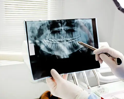 veneers (7).webp