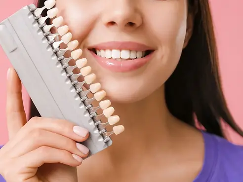 Veneers (11).webp
