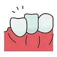 Veneers-_6_.webp