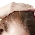 female-hair-transplant-_11_.webp