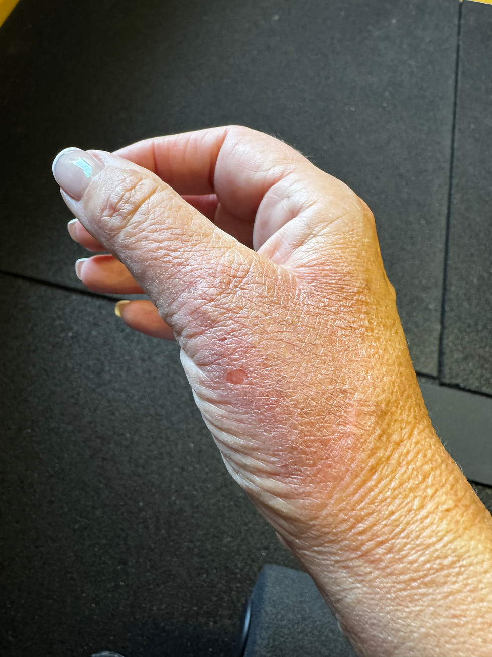 Selbsthypnose bei Verbrennungen – mein persönliches Erlebnis