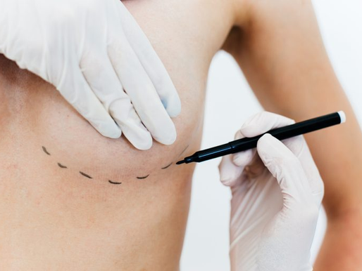 A Lei 15.171/25 amplia o direito das mulheres à cirurgia plástica reparadora de mama pelo Sistema Único de Saúde (SUS). A partir da vigência da lei, em quatro meses, o procedimento também será possível em caso de mutilação total ou parcial do órgão, independentemente da causa. Até então, a legislação previa essas operações no SUS apenas para casos relacionados ao tratamento de câncer.