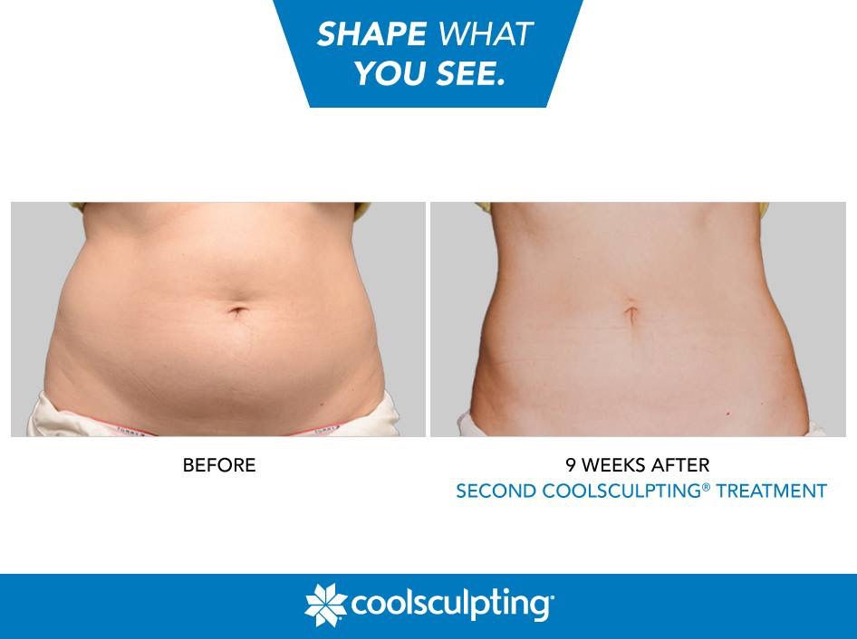 It's time to freeze the fat.