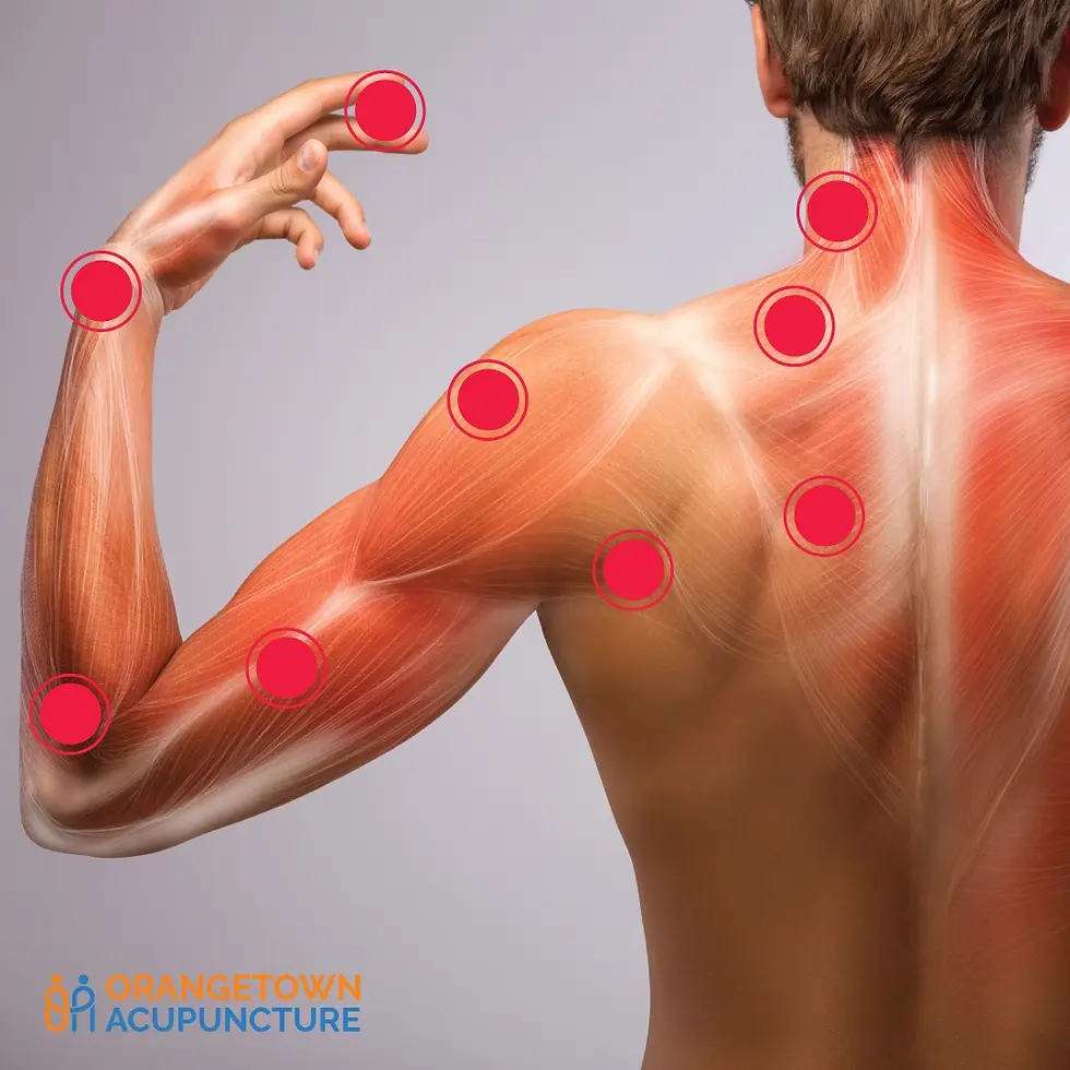 Illustration of cervical radiculopathy showing nerve pain from neck to shoulder and arm.