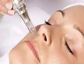 Dermapen.webp
