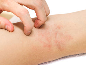 Dermatite atopique : comprendre la maladie et mieux la prendre en charge