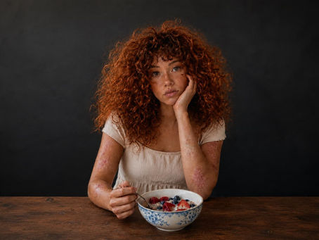 Could Psoriasis Begin in the Gut?