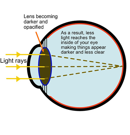 Illustration of an eye with a cataract