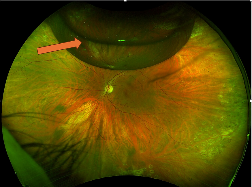 Retinal photo demonstrating a repaired retinal detachment with a residual gas bubble in eye