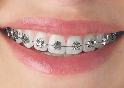 Teeth-EmpowerMetal_edited.jpg