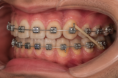 Élastique intermaxillaire avec bagues orthodontiques autoligaturantes, traitement orthodon