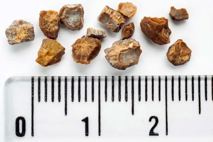 Kidney stones, or stones in the ureter (the tube that connects the kidney to the bladder), can cause pain in the lower back
