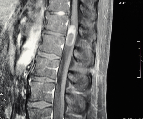 20-30% of tumors are intramedullary, meaning that they grow inside the spinal cord.