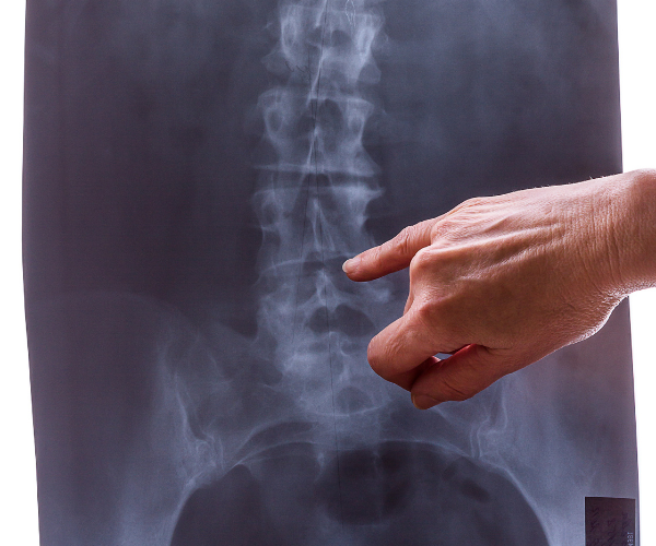 Your doctor can do some tests to see if you have sciatica.