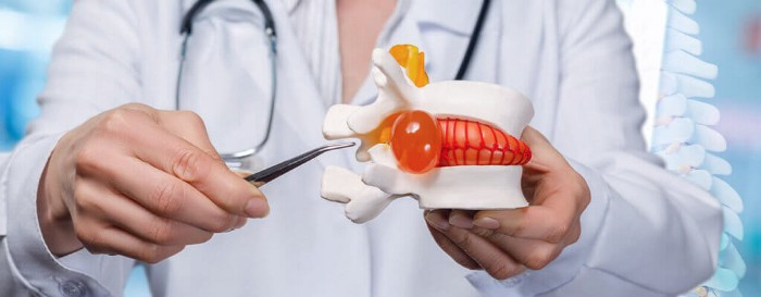 Bulging discs can put pressure on nerves, leading to significant pain.