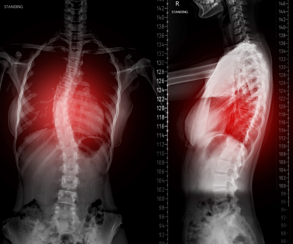 x-ray showing advanced scoliosis which can be debilitating.
