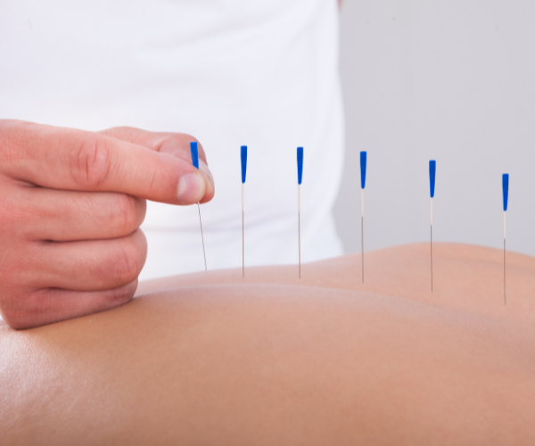 In acupuncture tiny needles are inserted into the body to target the energy or “qi” in the body to enable healing and reduce pain.