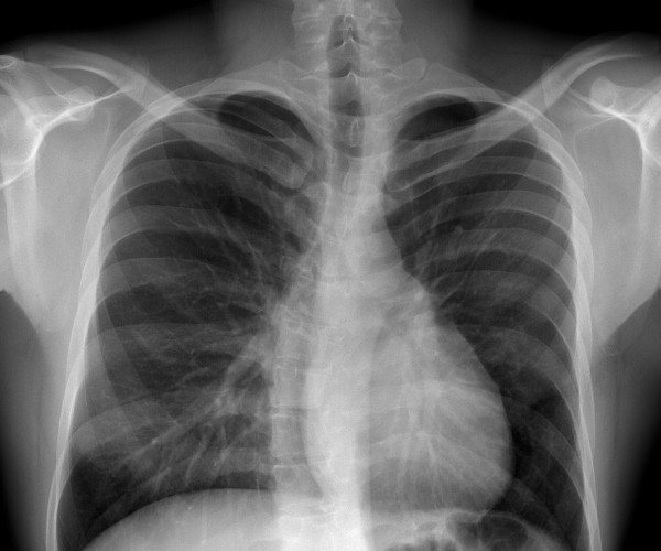 x-ray to see if there is degenerative scoliosis in the spine.