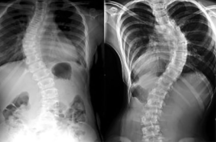 Scoliosis is a sideways curvature of the spine that can occur during the growth spurt just before puberty.