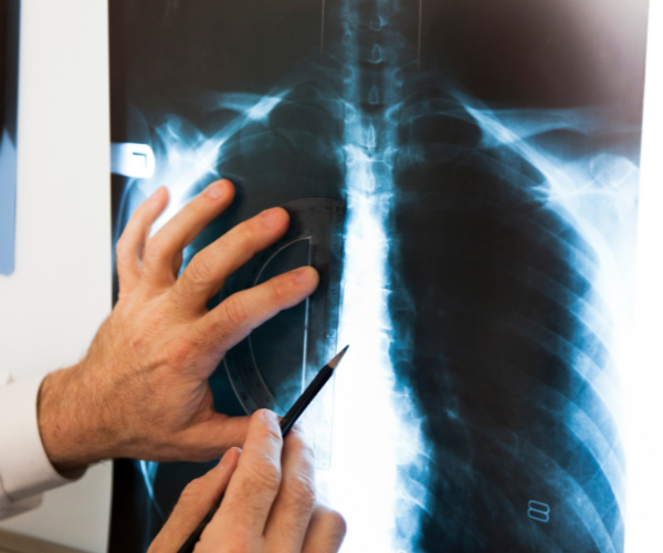 Arthritis of the spine is a more serious condition that can cause lower back pain.