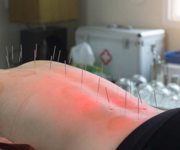 LivaFortis looks at the evidence to see if acupuncture works for back pain.
