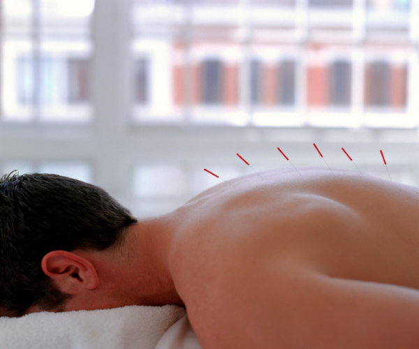 Acupuncture involves the insertion of very thin needles through your skin at strategic points on your body, called “acupoints”.