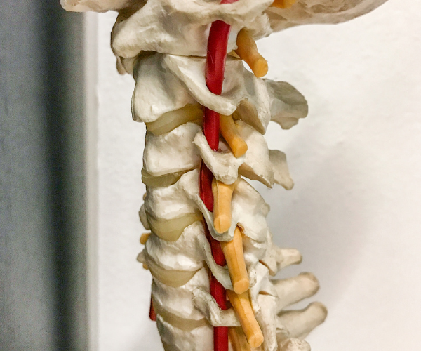 The most common cause of spinal stenosis is osteoarthritis.