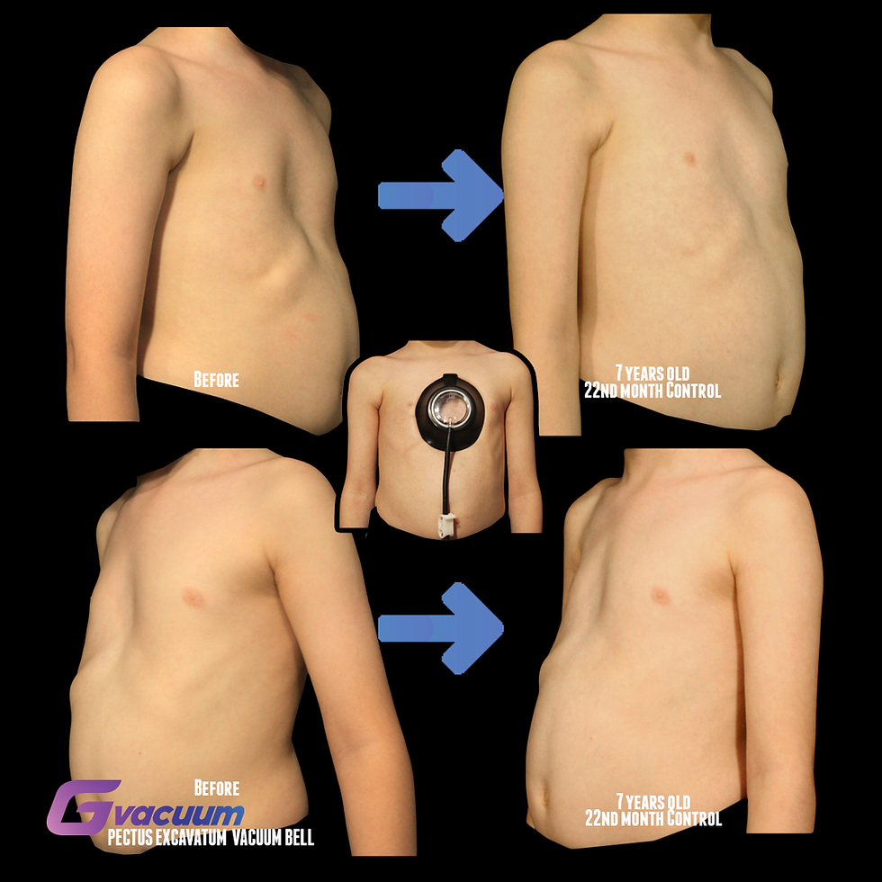pektus vakum bel iyileşme pectus vacuum bell healed