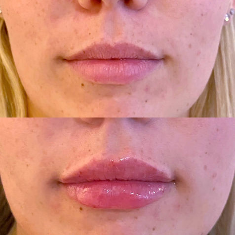 Juvéderm to lips