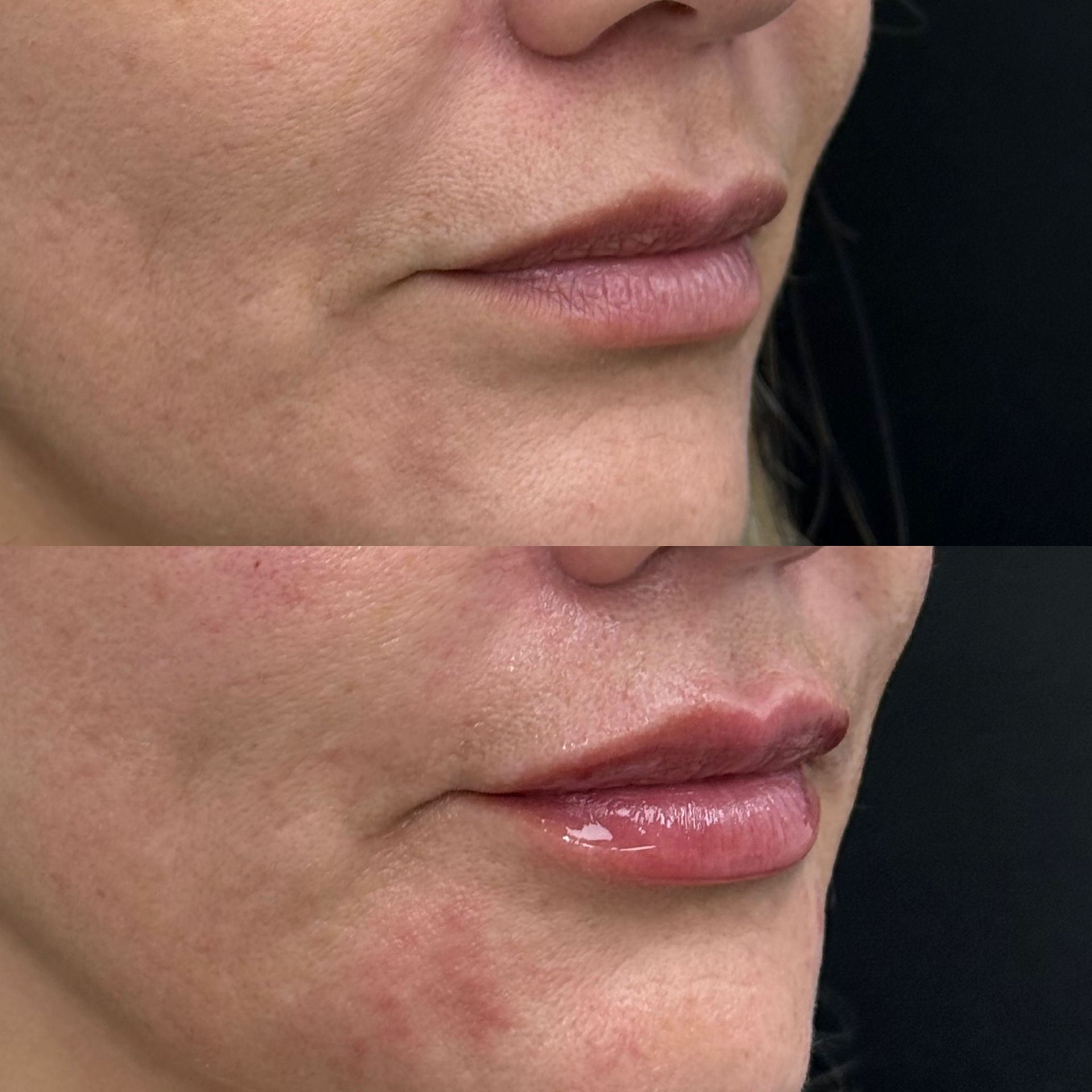 Before and After lip filler