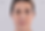 Sculptra before and after photo