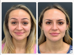 before and after Botox results at Apex Aesthetics and Wellness, Palm Beach Gardens FL