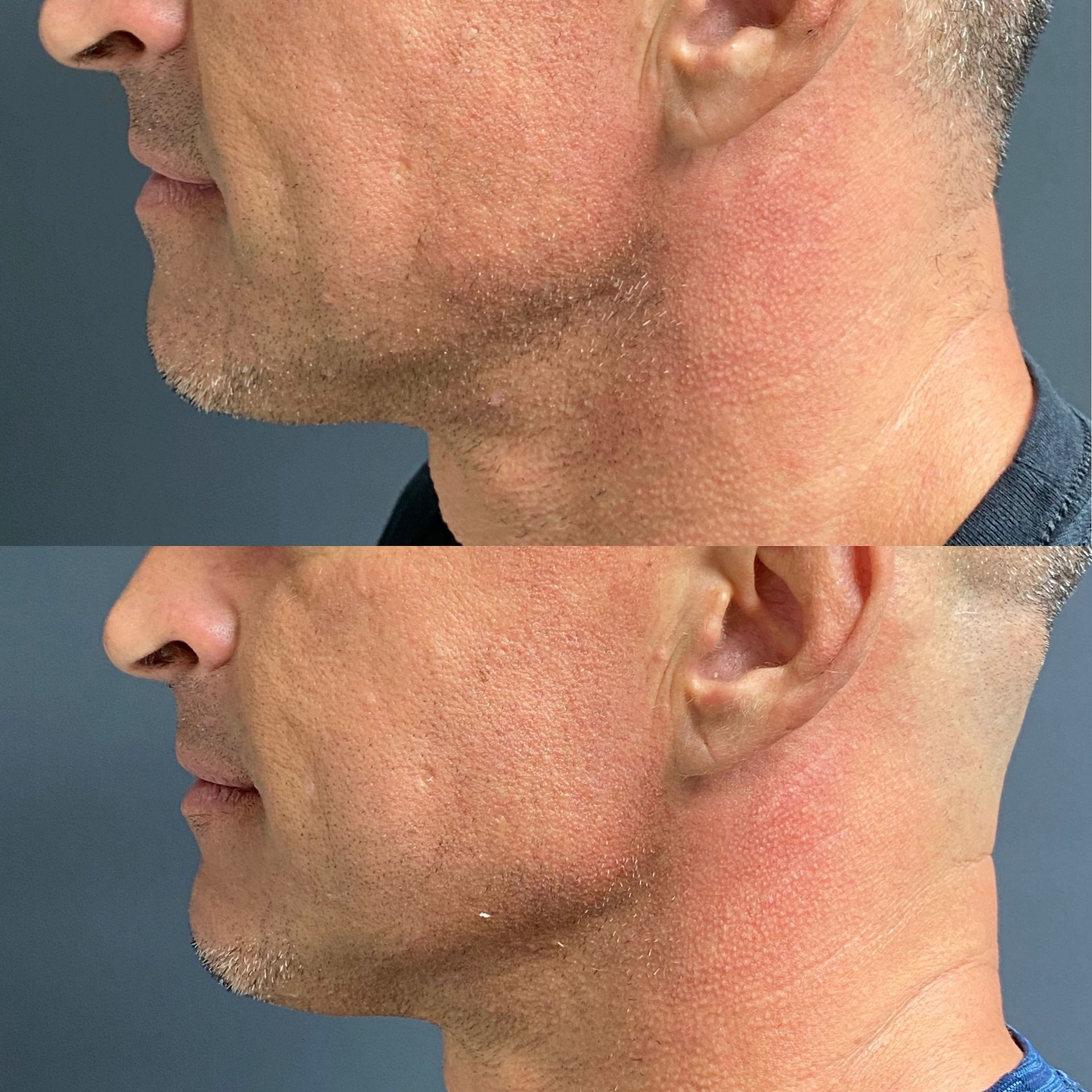 Before and After dermal filler to the jaw