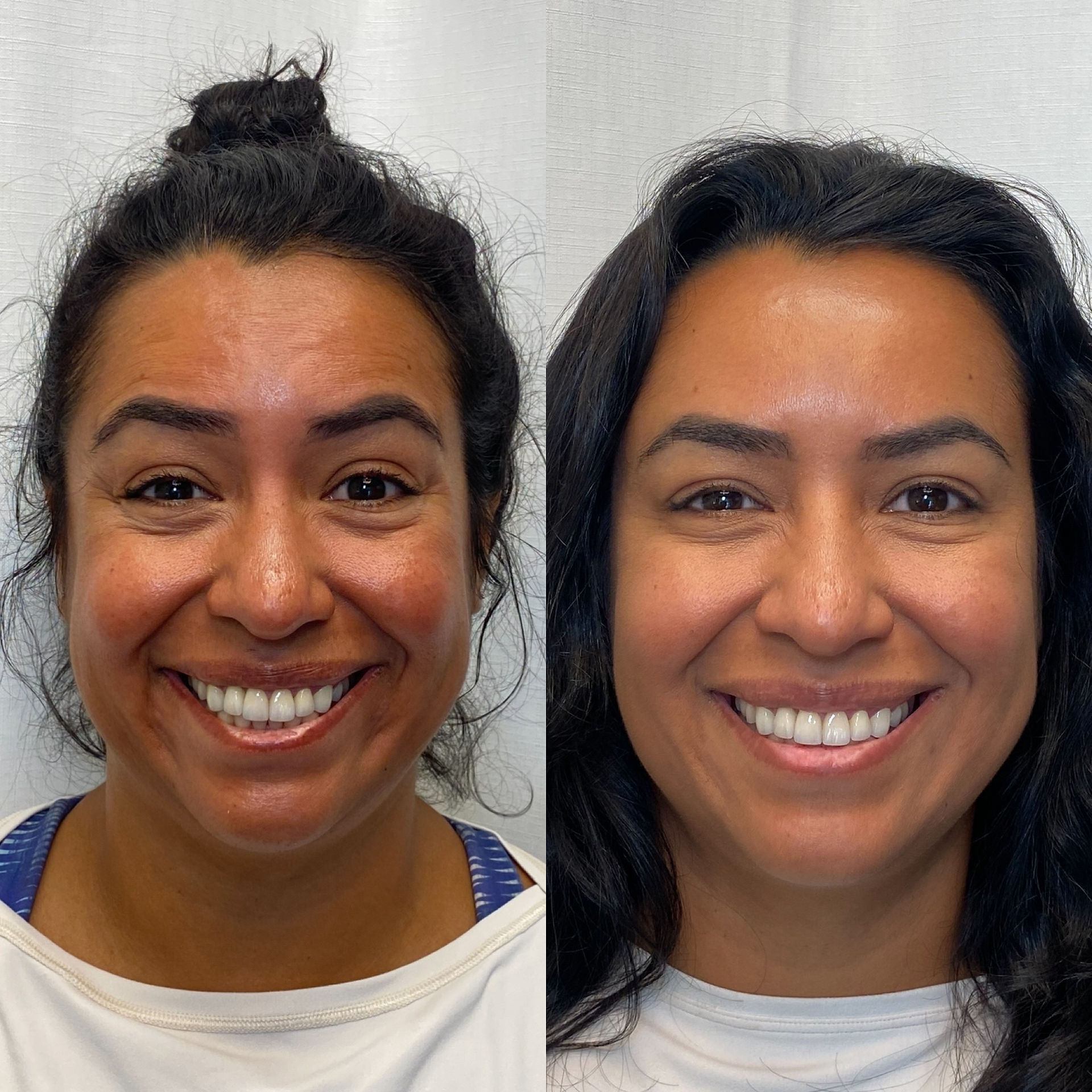Botox Forehead, Glabella, crow's feet