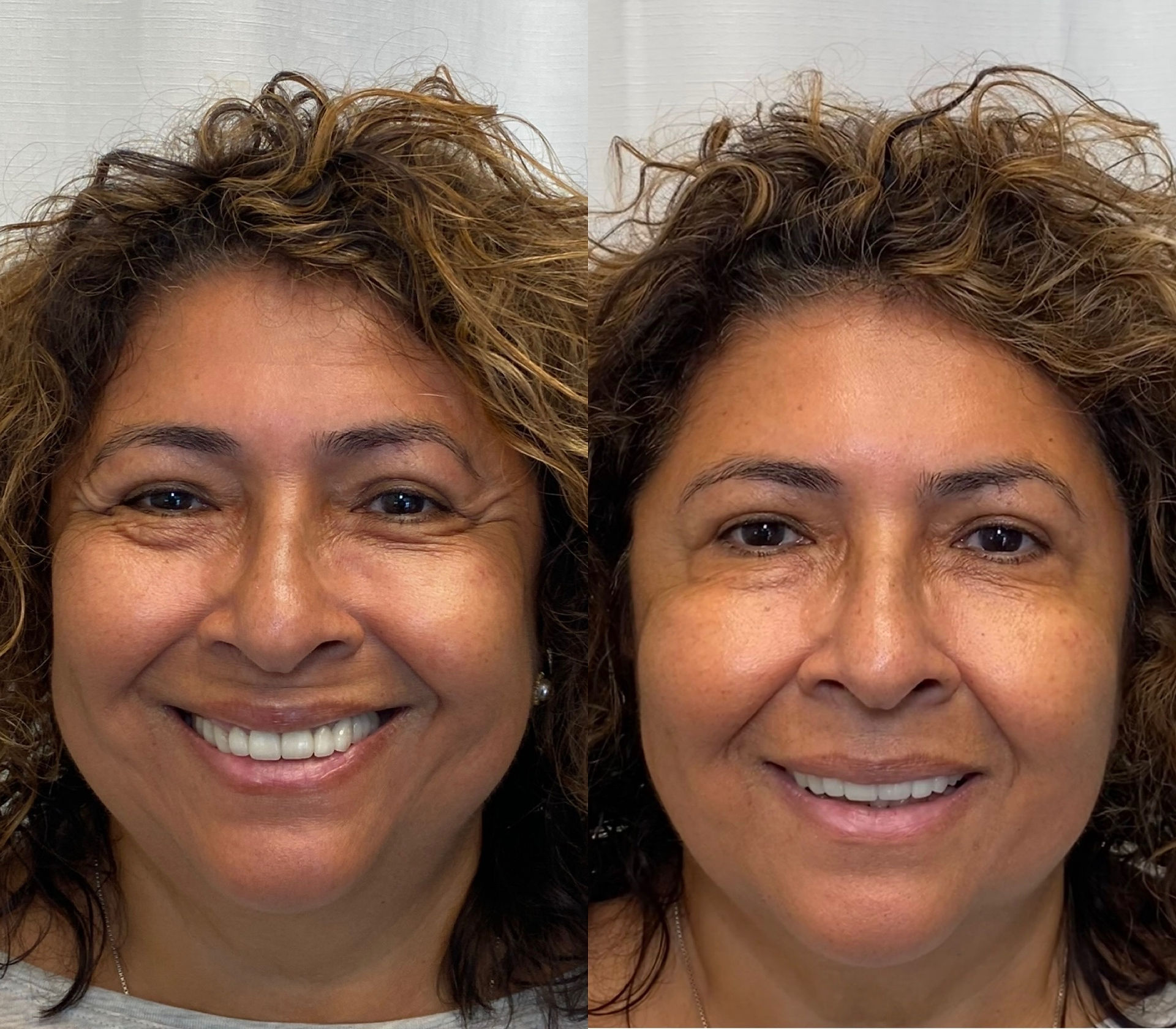 Before + After: Forehead, Glabella, crow's feet