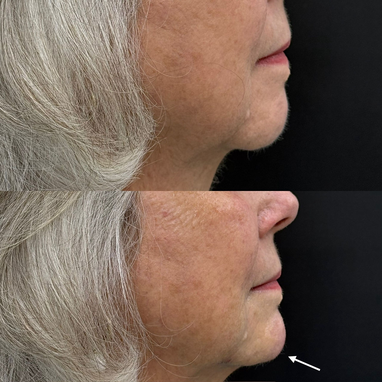 Before and After chin filler