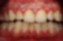 gum-disease-blog.jpg