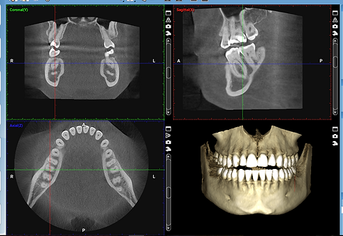 Cone Beam Imaging (CBCT Scan) NJ Smile Center by Dr. Vocaturo in Colts Neck, New Jersey