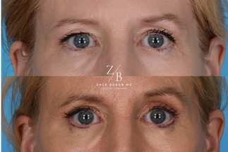Blepharoplasty - Dr. Borab