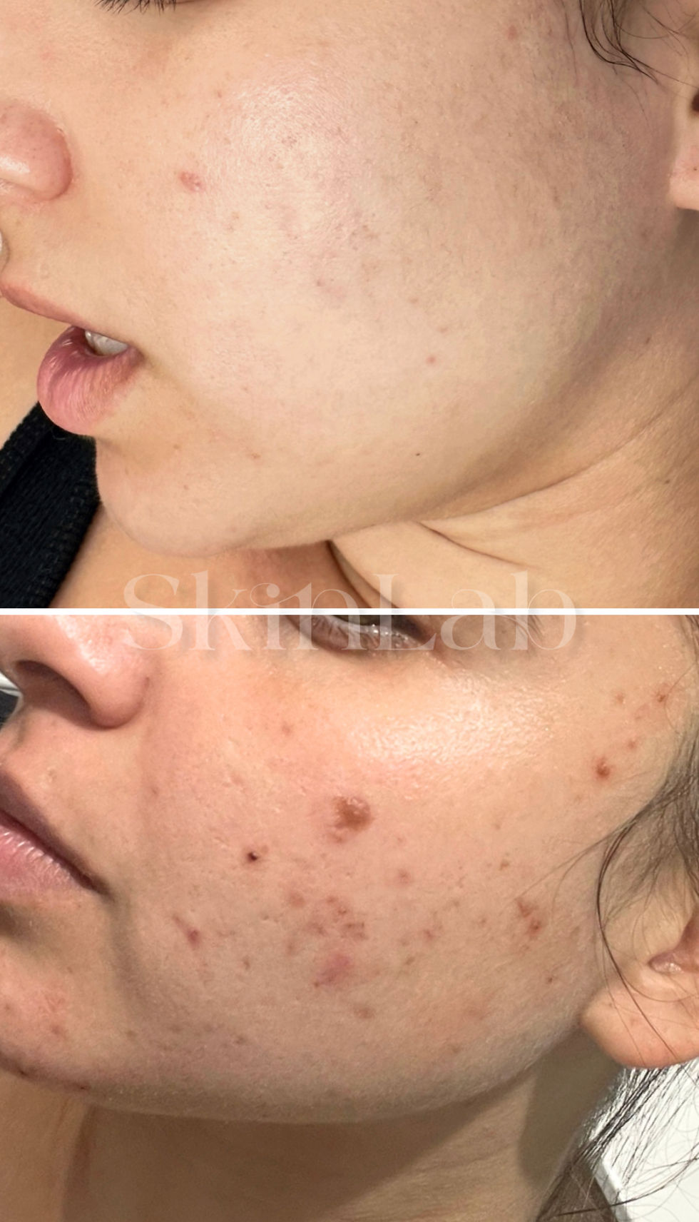 תמונה ממוזערת: אקנה ביו - דרמלוסופי אקנה