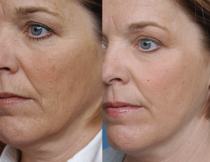 Laser-skin-resurfacing.gif