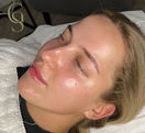 Chemical Peel Wirral
