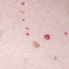 Cherry Angiomas removal skin treatment in Tamworth