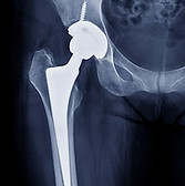Protese-total-de-quadril.