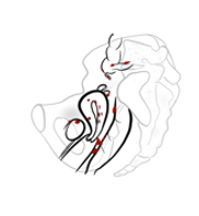 endometriose.png